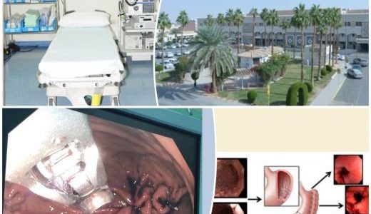 مستشفى الملك سعود بعنيزة يطلق عمليات كرمشة المعدة