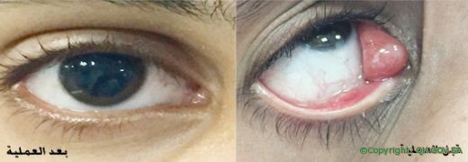 أطباء العيون بمركزي بريدة ينهون معاناة مريض من كتلة لحمية بالعين