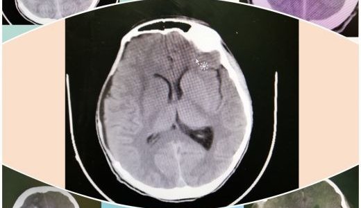 أطباء مستشفى الملك سعود بعنيزة  ينقذون حياة شاب سعودي تعرض لإزاحة شديدة في المخ